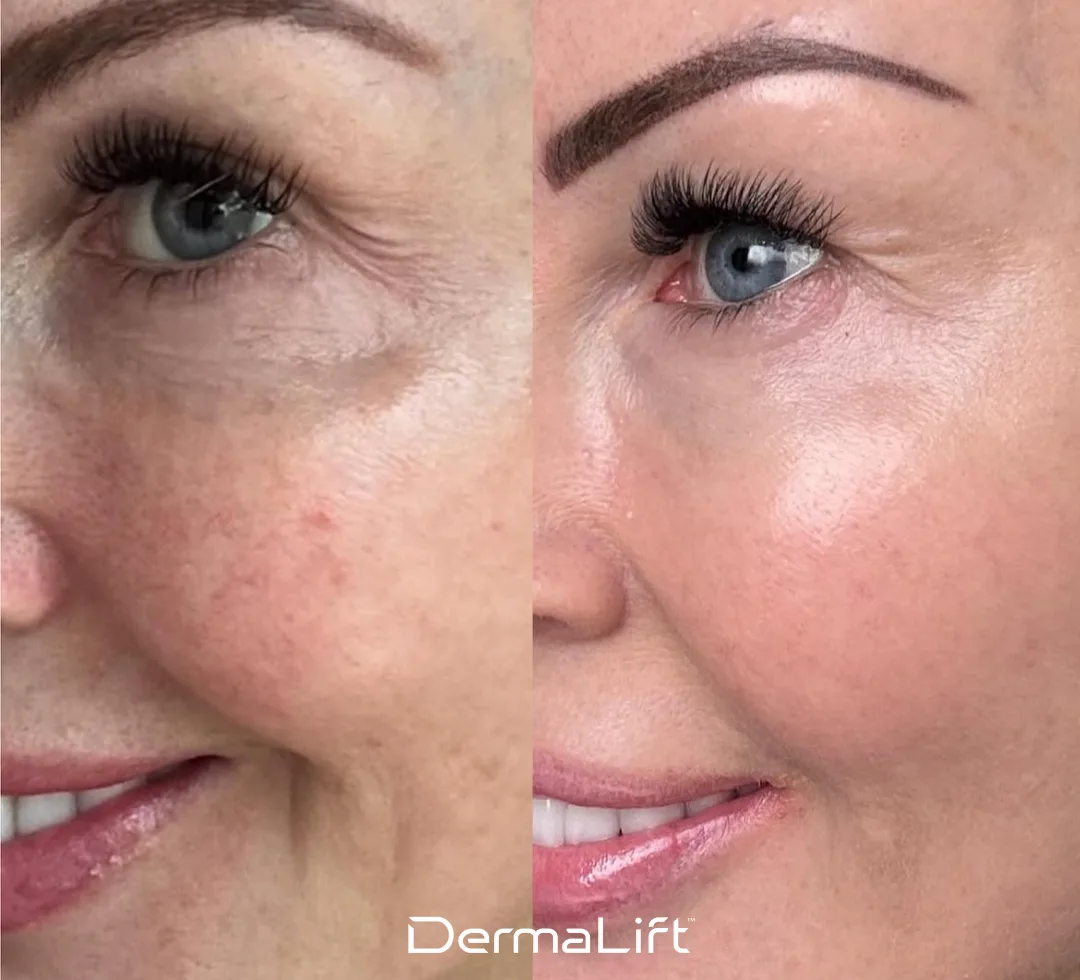 DermaLift Before And After