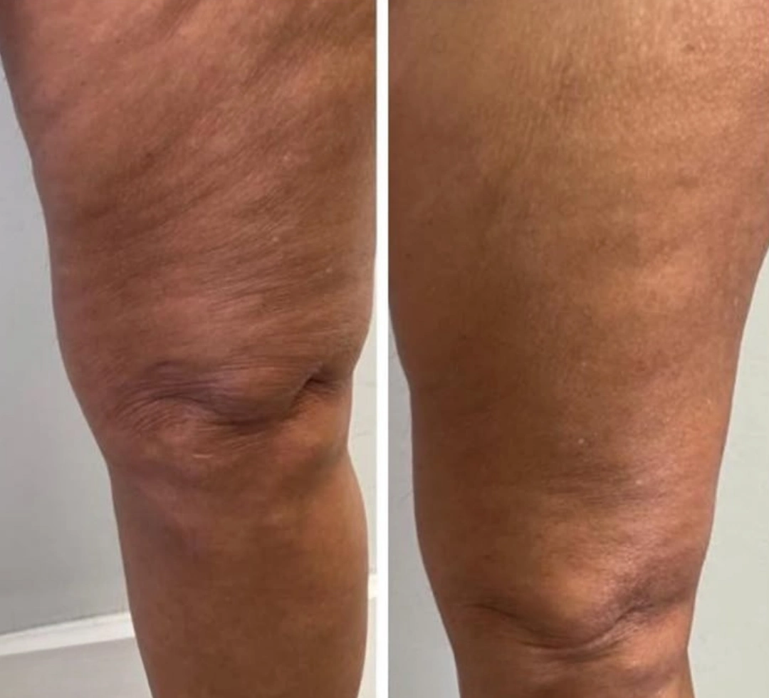 LipoSculpt customer review