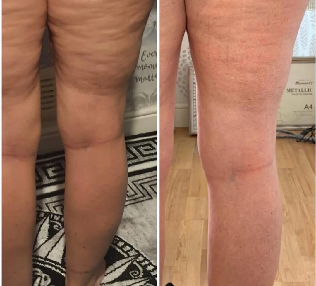 LipoSculpt customer review