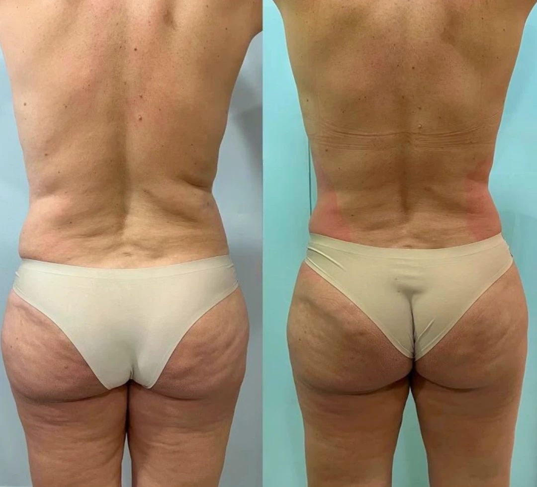 LipoSculpt customer review