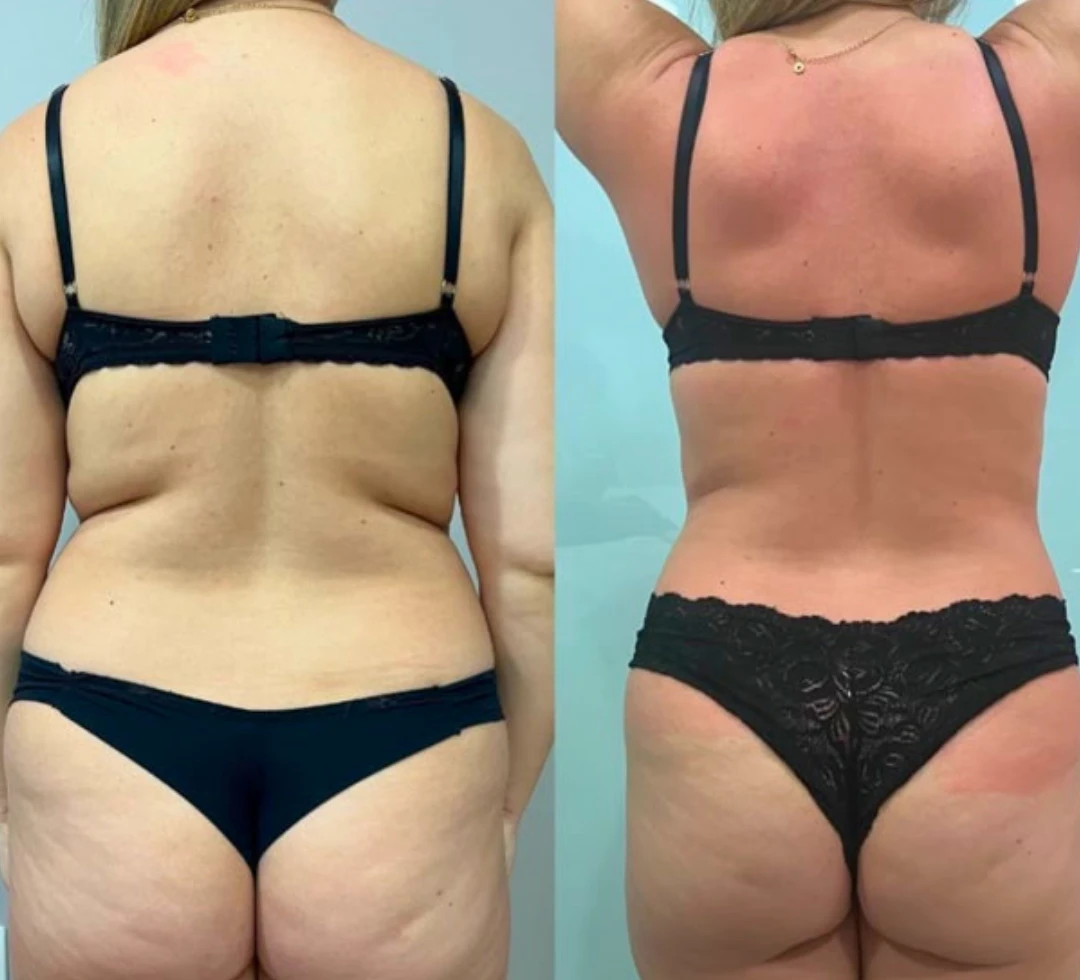LipoSculpt customer review