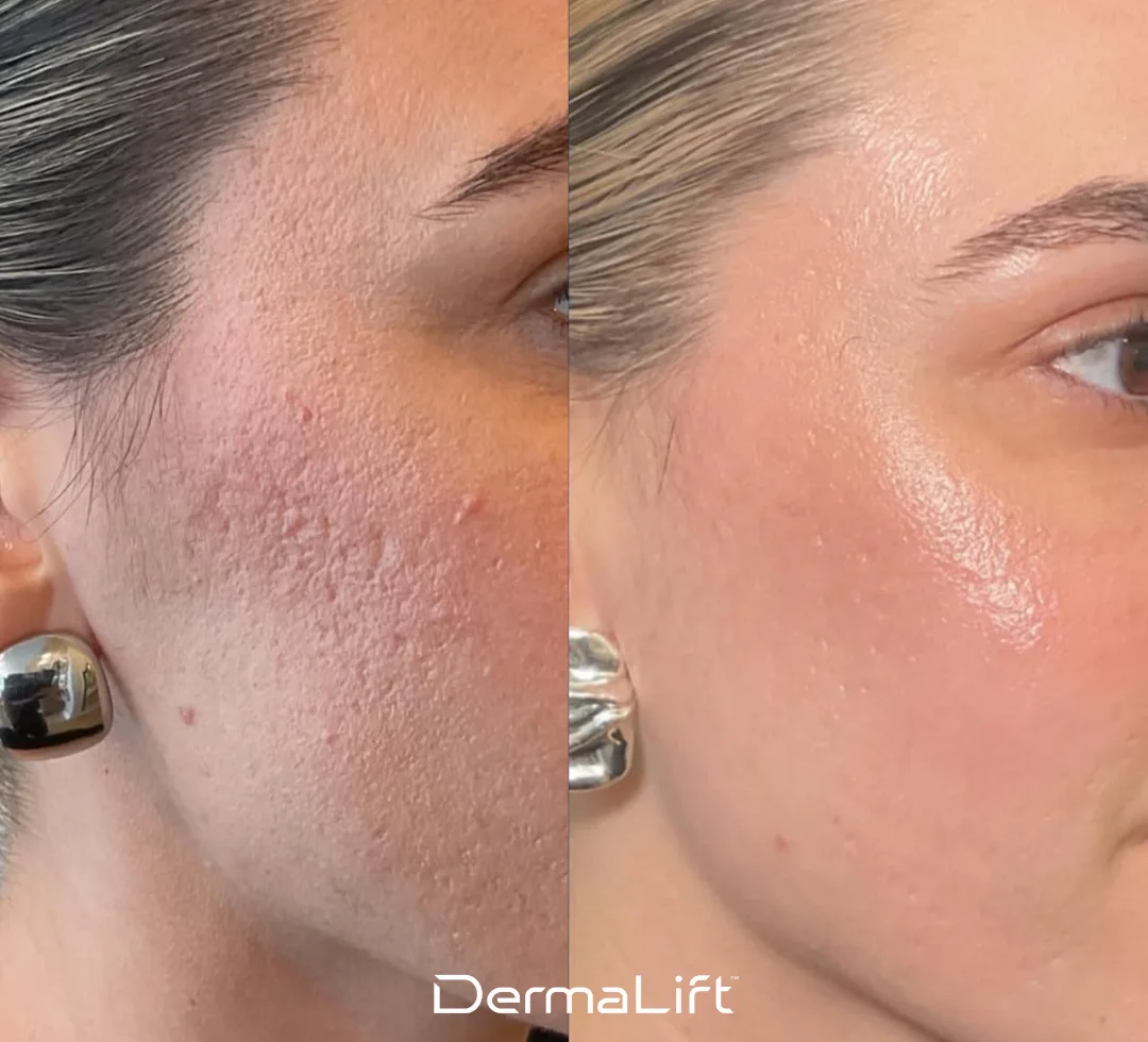DermaLift Before And After