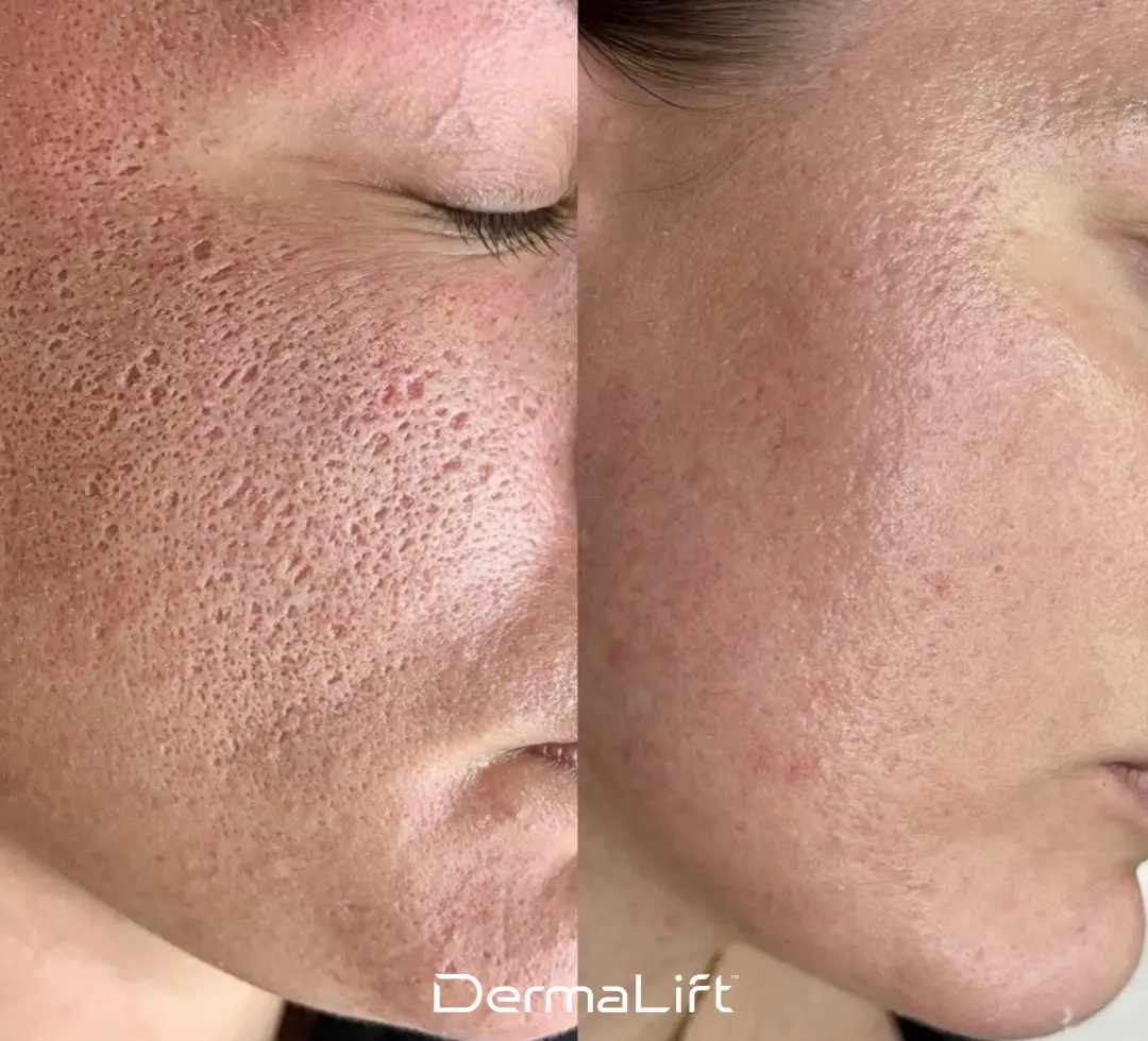 DermaLift Before And After